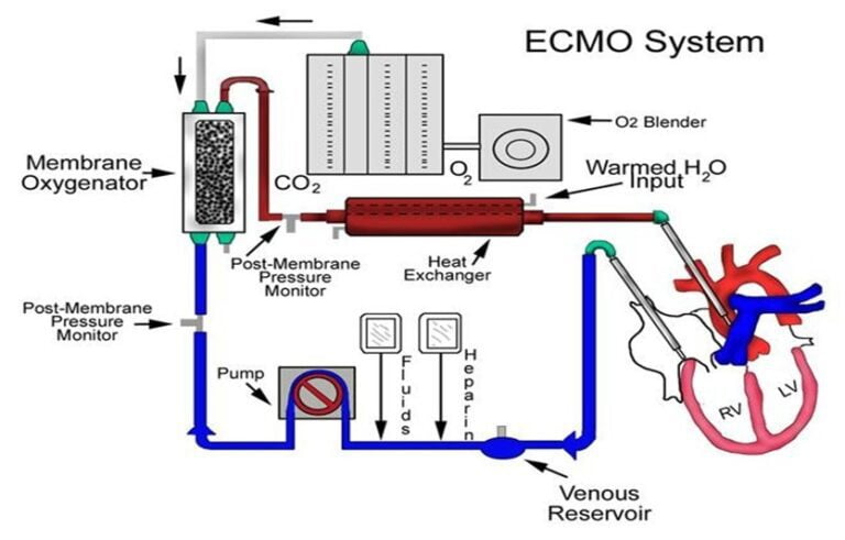 What is an ECMO Machine