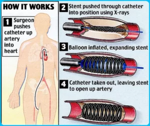 what is Stents and Angioplasty