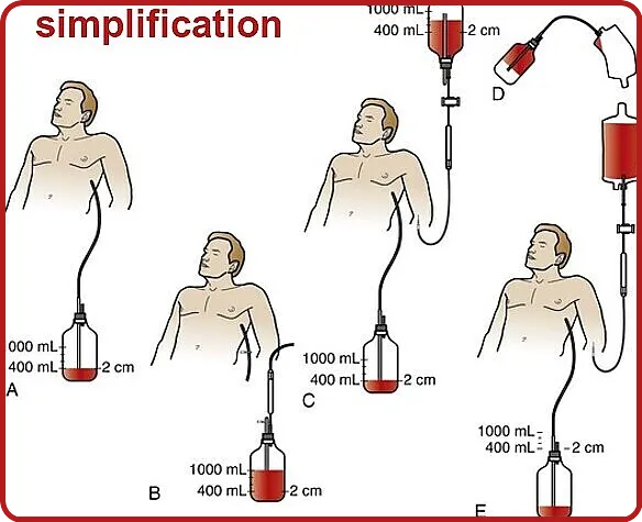 Autotransfusion units Function and Working Principle