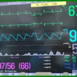 What is Capnography How to Capnography work