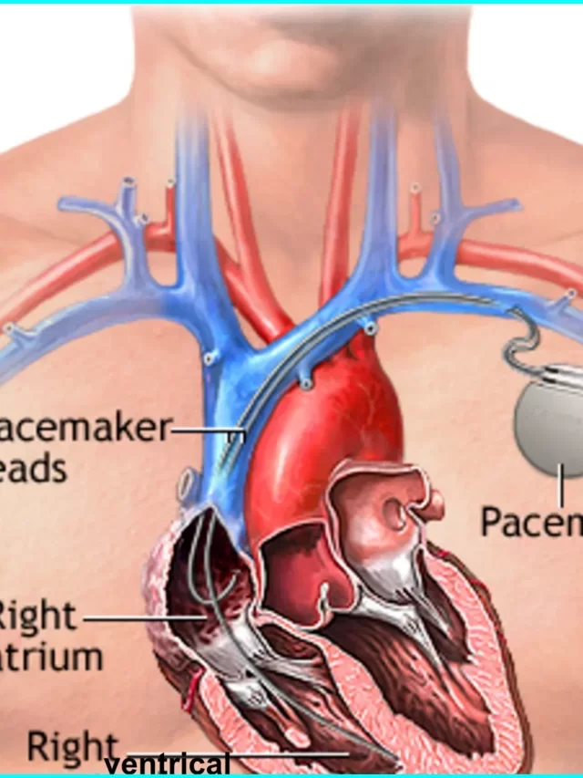 What is pacemaker and how to work, principle, type