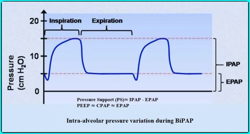 What is BIPAP?