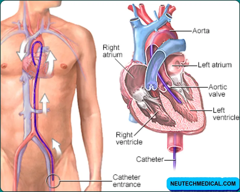 cardiac catheterization, what is cardiac catheterization, cardiac catheterization procedure, cardiac catheterization purpose, Right Heart Cath
