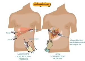 cholecystectomy pronunciation, cholecystectomy icd 10,