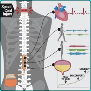 electrical stimulation of damaged areas of the spinal cord, paralysis