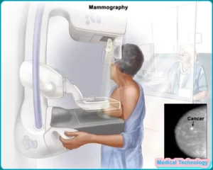 mammography, diagnostic mammography, Screening Mammogram, mammogram near me3