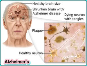 Alzheimer's, Early signs of alzheimer's