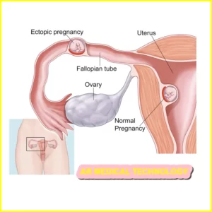 6 week ectopic pregnancy ultrasound