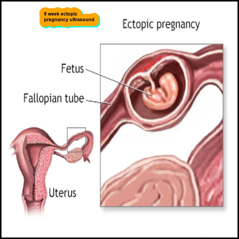 9 week ectopic pregnancy ultrasound