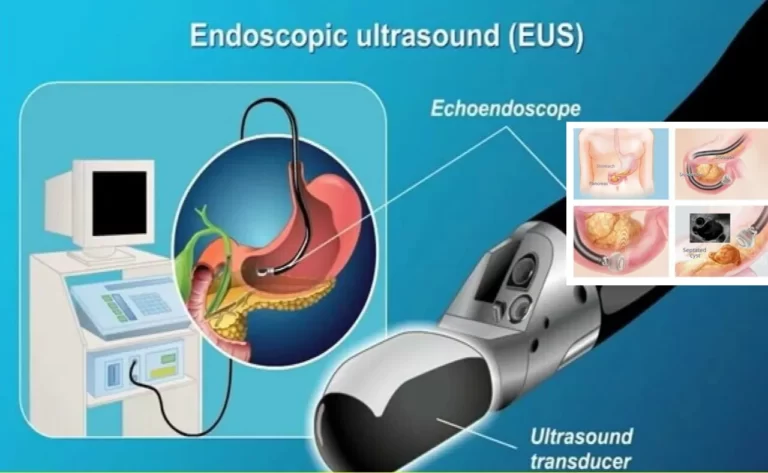 Endoscopic Ultrasound