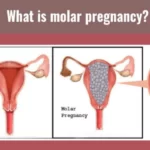 Can you tell a molar pregnancy from ultrasound?