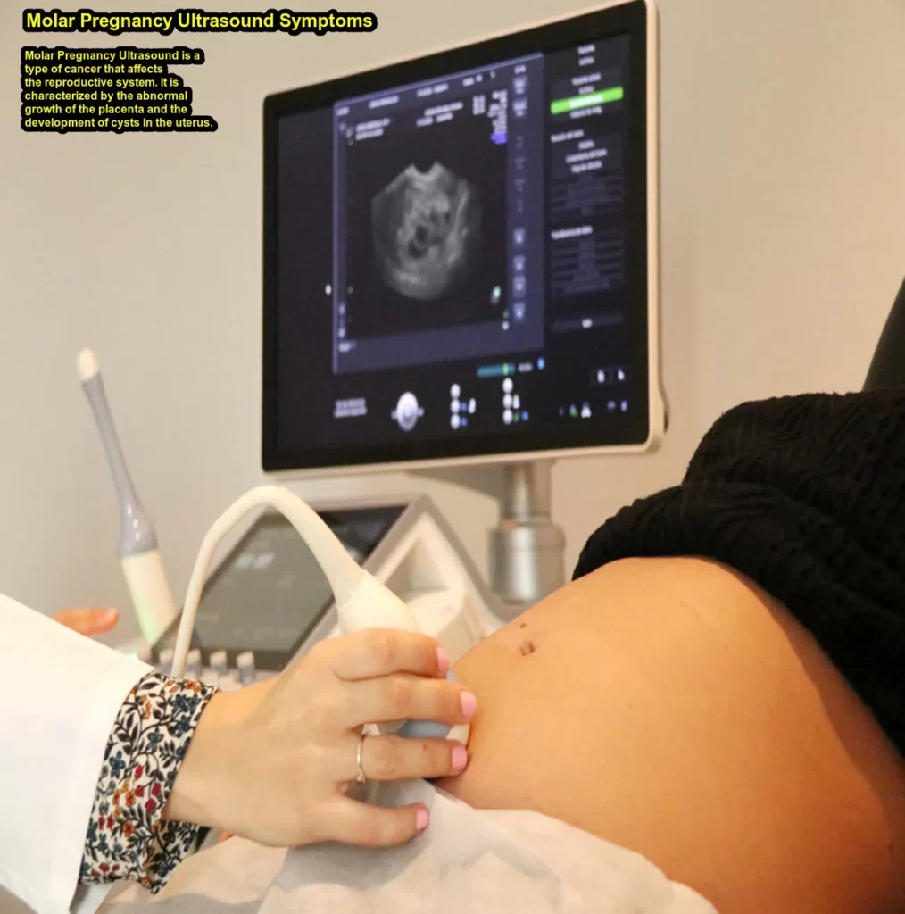 Molar Pregnancy Ultrasound