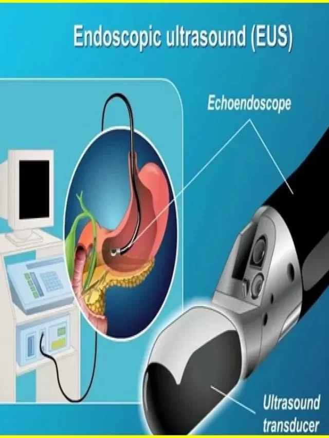 What is the Endoscopic Ultrasound: Best Procedure2023
