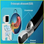 Endoscopic Ultrasound, Endoscopic Ultrasound Pancreas, Endoscopic Ultrasound of Pancreas, Endoscopic Ultrasound Cpt Code..