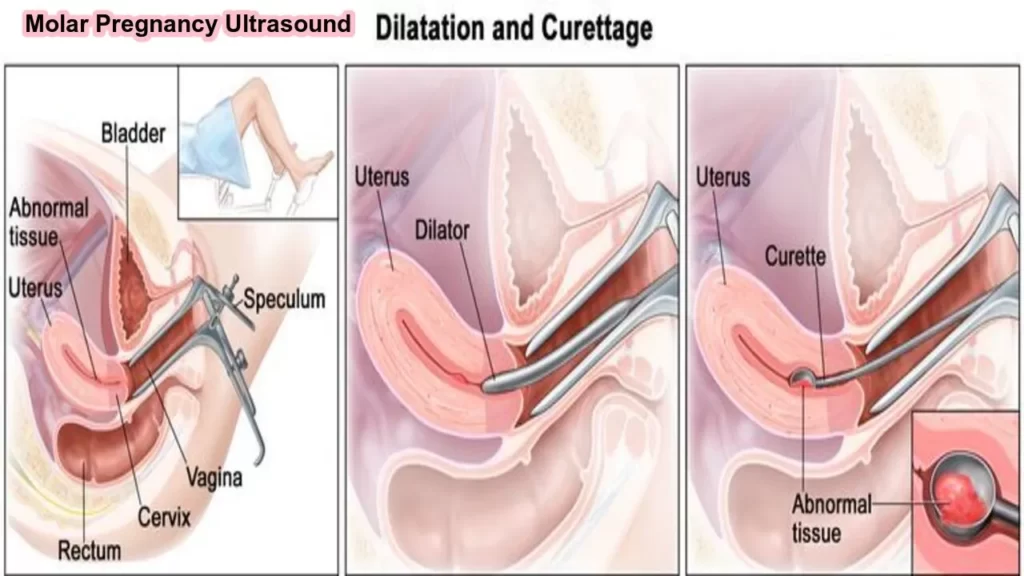 How does a molar pregnancy appear on ultrasound?