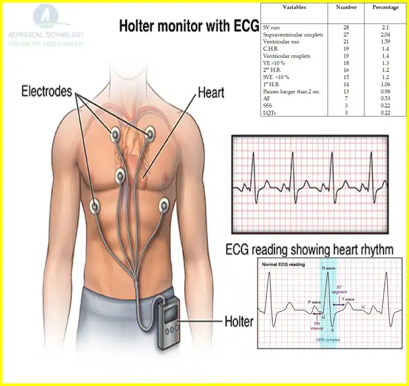 abnormal holter monitor results