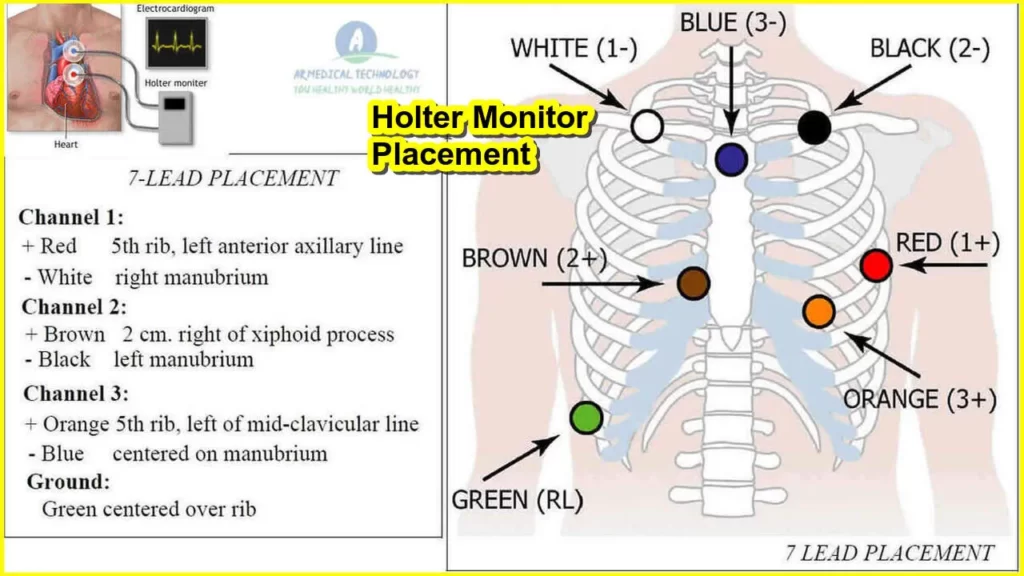 Holter Monitor Placement