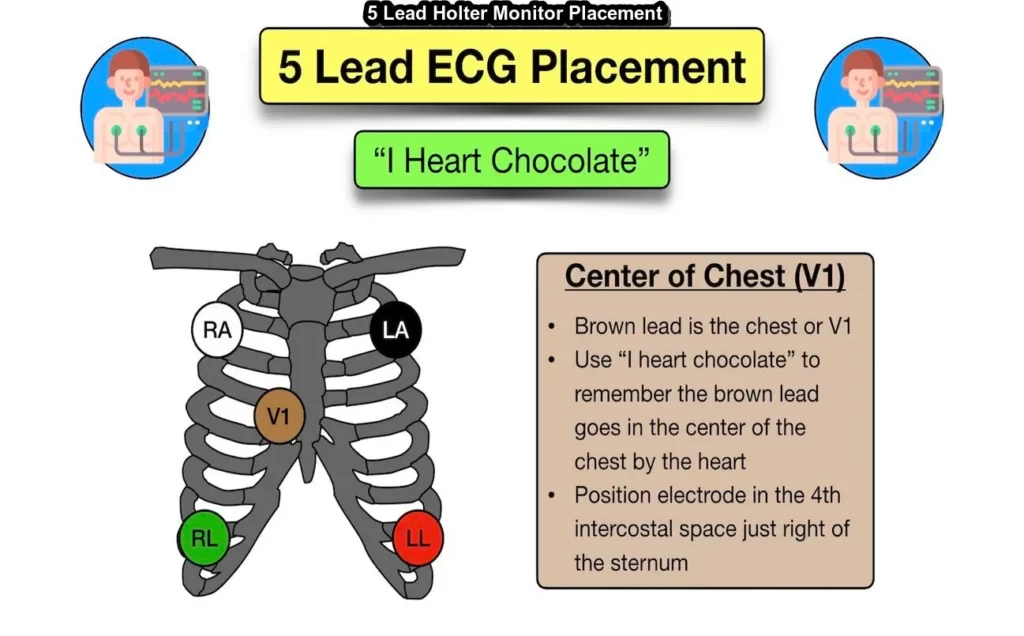 5 Lead Holter Monitor Placement